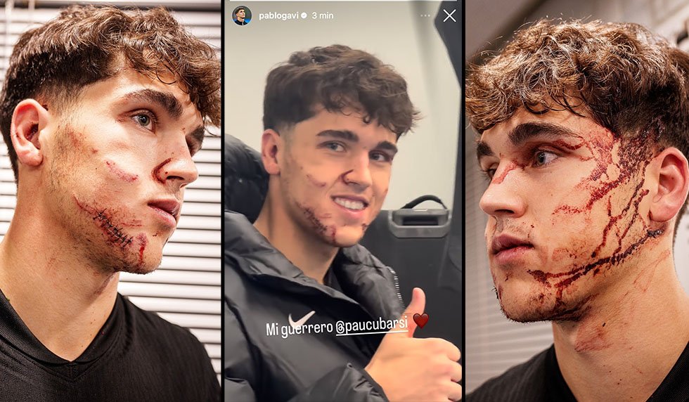 Mit zehn Stichen genäht: Cubarsí erlebt in Belgrad blutigen Abend